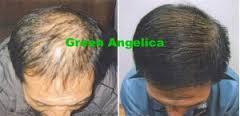 serum green angelica mengatasi kebotakan parah
