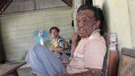 (ironis!!!!) Dipenuhi Benjolan Malah Jadi Tontonan Pegawai RS