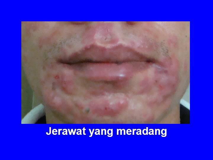 KENALI JERAWAT DAN MENGHILANGKANNYA GAN