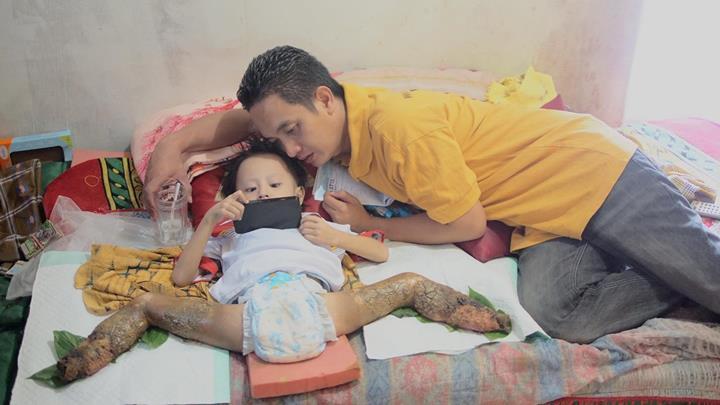 &#91;HELP ELDA&#93; BU RISMA... TOLONGLAH BALITA YANG MENGALAMI DEKOMPOSISI KAKI INI BU