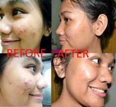 Obat Jerawat Alami dan Paling Ampuh