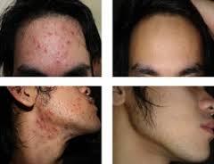 Obat Jerawat Alami dan Paling Ampuh
