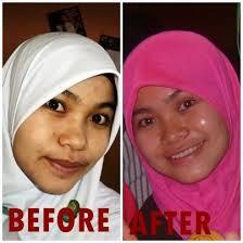 Obat Jerawat Alami dan Paling Ampuh