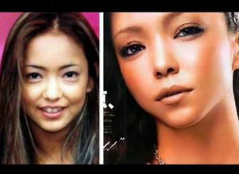 Wajah Tetsu Bassist Larc en Ciel Sebelum Operasi