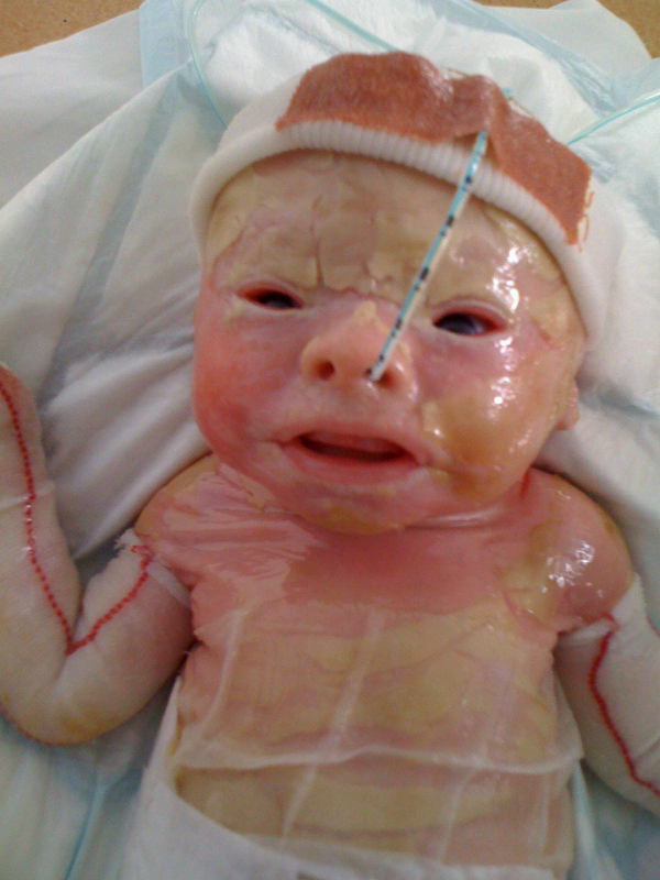 Mengenal HARLEQUIN ICHTYOSIS Orang2 Sering Menganggap Penderita Sebagai Bayi Monster