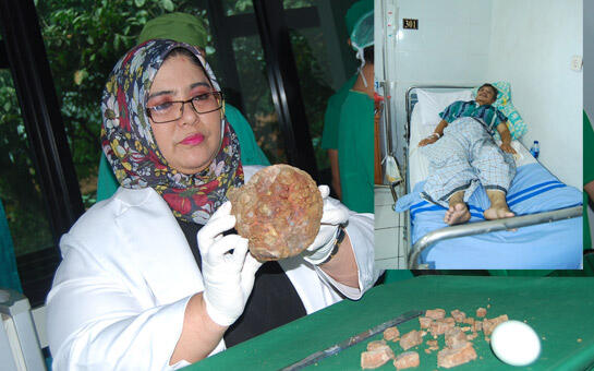 DITEMUKAN BATU SEBERAT 2KG DI DALAM TUBUH MANUSIA