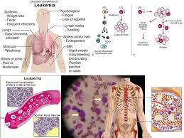 Sedikit Hal Tentang Leukemia ..
