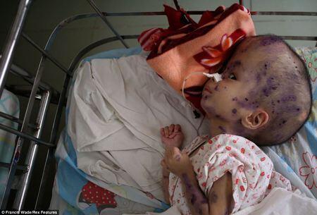 Terungkap! Anak-Anak Korban Senjata Kimia 40 Tahun Silam