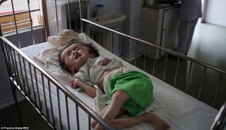 Terungkap! Anak-Anak Korban Senjata Kimia 40 Tahun Silam