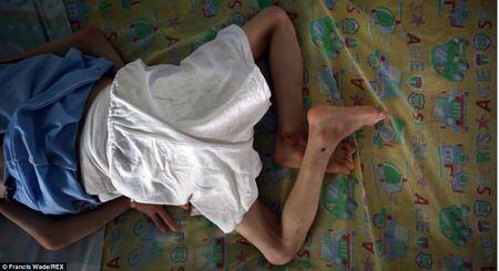 Terungkap! Anak-Anak Korban Senjata Kimia 40 Tahun Silam