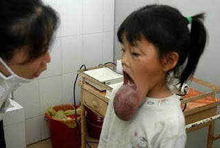 TUMOR PALING GANAS SEPANJANG SEJARAH MEDIS