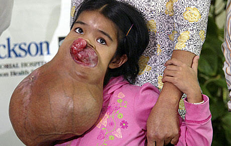 TUMOR PALING GANAS SEPANJANG SEJARAH MEDIS