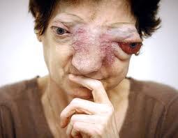 TUMOR PALING GANAS SEPANJANG SEJARAH MEDIS