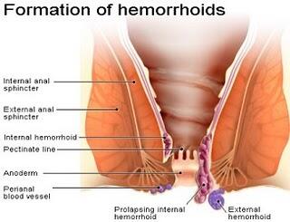 9 Hal Pemicu Munculnya Wasir