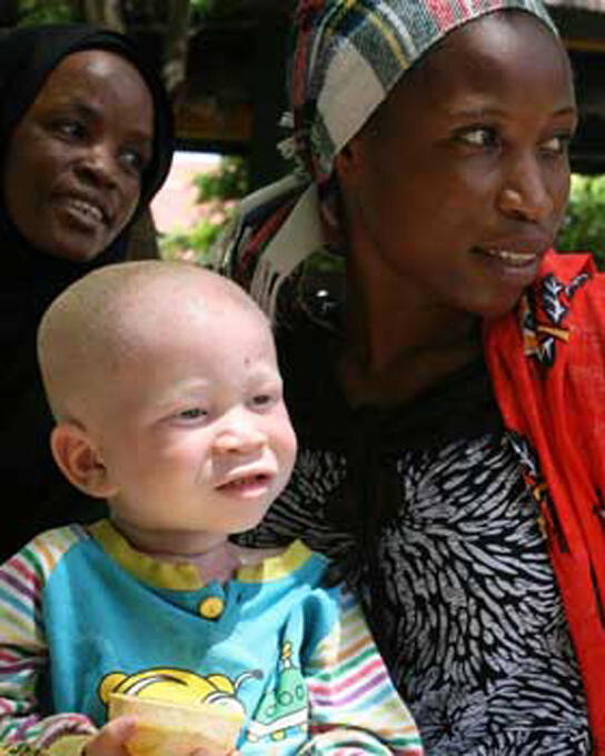Apa itu albino? dan apa penyebab nya??