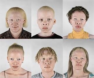 Apa itu albino? dan apa penyebab nya??