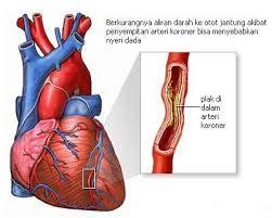 DAMPAK BURUK MALAS BEROLAHRAGA DIPAGI HARI..!!!