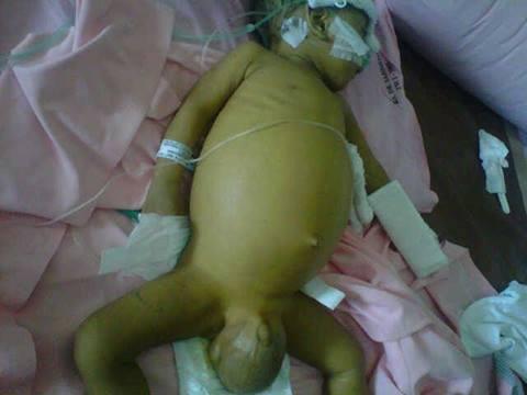 Vote & Donate for : Fatah - Bayi umur 8 bulan dengan penyakit Atresia Biliaris