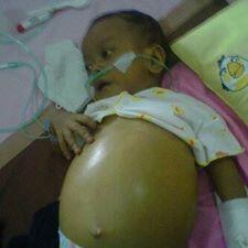 Vote & Donate for : Fatah - Bayi umur 8 bulan dengan penyakit Atresia Biliaris