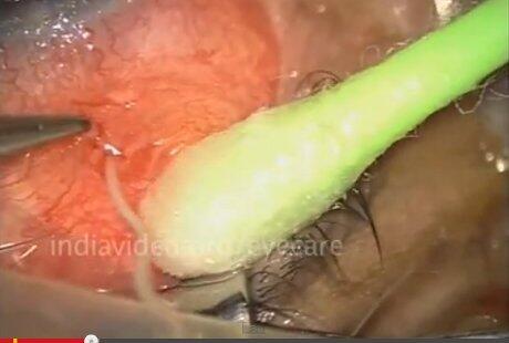 DANGEROUS WORMS FOR HUMAN ALIAS CACING YANG BERBAHAYA GAN