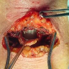 Leher Pria Ini Bolong Gara-gara Rokok