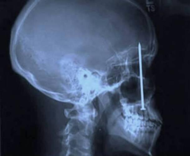 GAMBAR HASIL X RAY YANG PALING MENCENGANGKAN