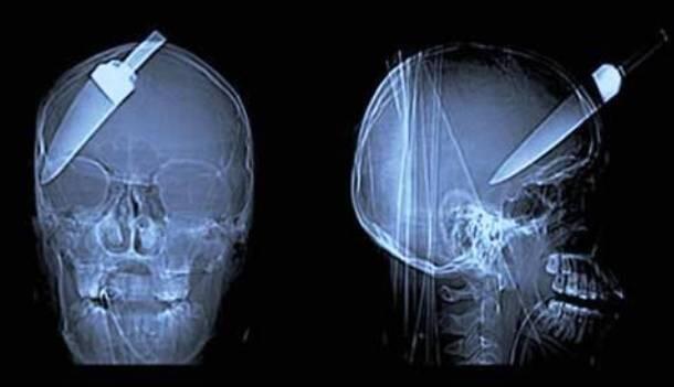 GAMBAR HASIL X RAY YANG PALING MENCENGANGKAN