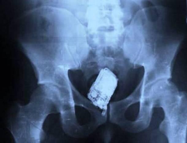 GAMBAR HASIL X RAY YANG PALING MENCENGANGKAN