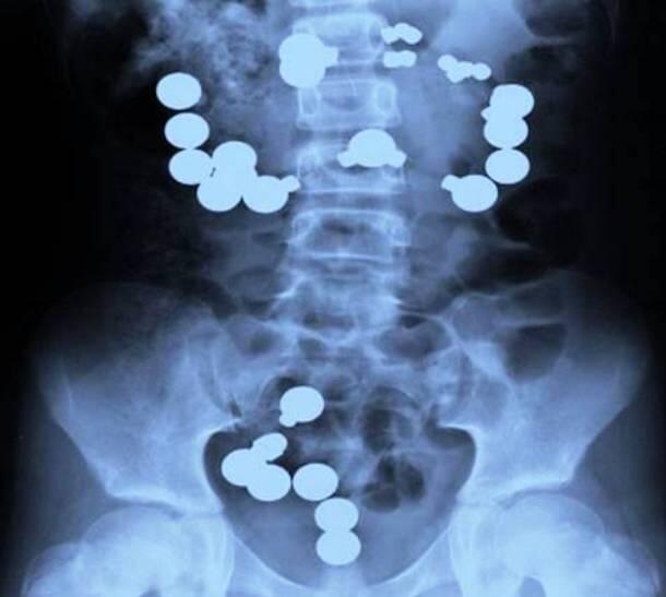 GAMBAR HASIL X RAY YANG PALING MENCENGANGKAN