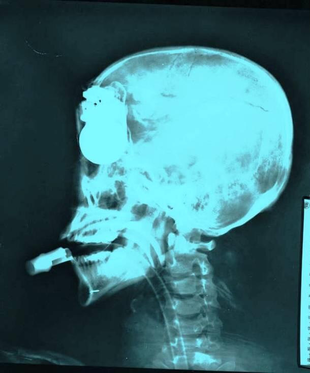 GAMBAR HASIL X RAY YANG PALING MENCENGANGKAN