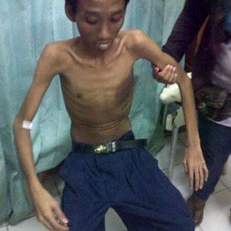 &#91;Bantuan Dana&#93; untuk Saudara kita Rengga Bartolomeus Putra