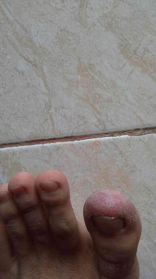 (HELP ME) Penyakit Eksim/eczema/dermatitis 