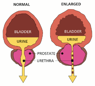 Obat Herbal Pembengkakan Prostat Yang Mujarab