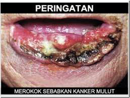 Gambar2 iklan anti rokok yg makin serem.