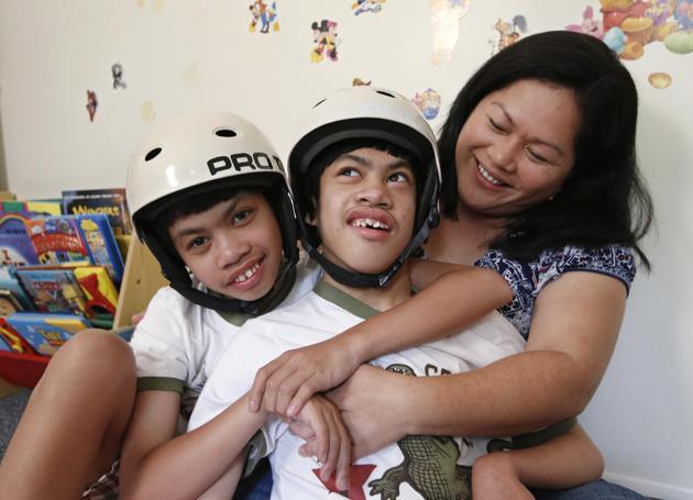 Kehidupan buat anak kembar siam Filipina