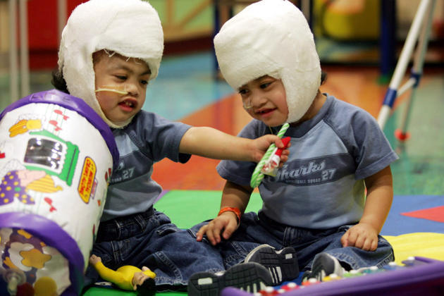Kehidupan buat anak kembar siam Filipina