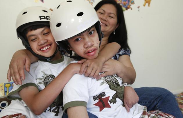 Kehidupan buat anak kembar siam Filipina