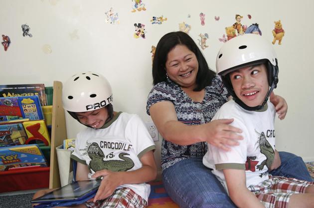Kehidupan buat anak kembar siam Filipina