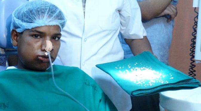 Aneh Tapi Nyata, Dokter Cabut 232 Gigi dari Mulut Remaja India