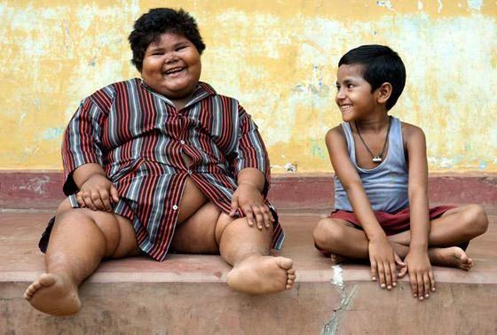 Perempuan 9 Thn, BB 92 Kg, Seminggu Melahap 14 Kg Beras, 8 Kg Kentang, Ratusan Pisang