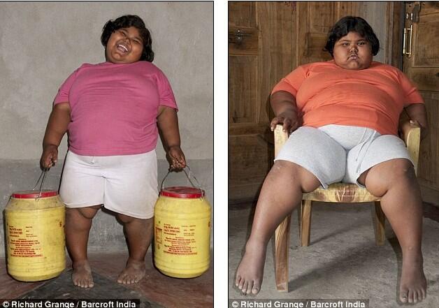 Perempuan 9 Thn, BB 92 Kg, Seminggu Melahap 14 Kg Beras, 8 Kg Kentang, Ratusan Pisang