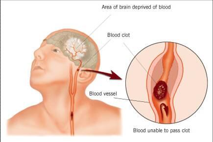 TIPS menangani STROKE &#91;alami tanpa obat&#93;