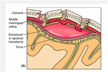 Hematoma Intracranial, Silent Rider Para Bikers