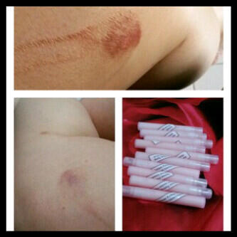 Peeling Dokter Pencerah Bekas Luka
