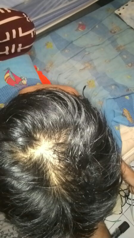 Pakar ubun-ubun rambut tolong ane