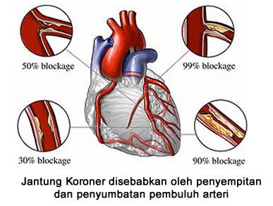 Jenis-jenis Penyakit di Seputar Jantung