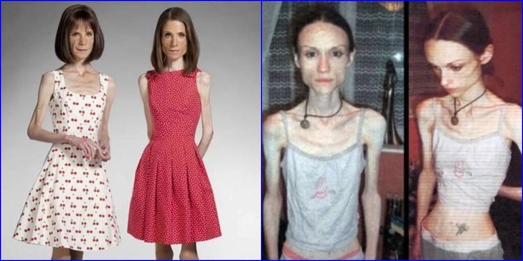 &#91;MENGERIKAN&#93; Alami Anoreksia, Tubuh Mereka Kurus Tinggal Tulang Belulang