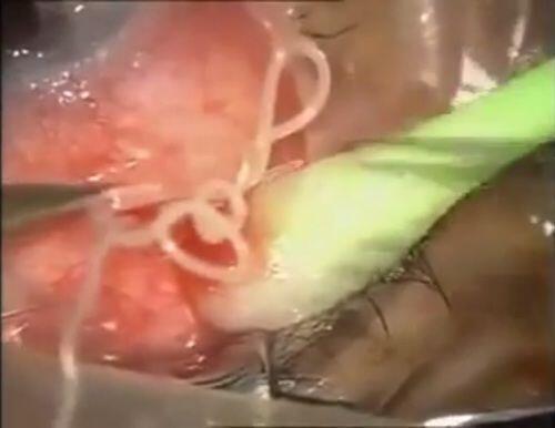 Warning! Buat Pengguna Softlense alias Lensa Kontak