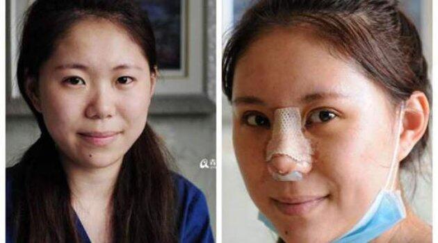Muak dengan Makeup, Wanita Ini Pilih Operasi Plastik