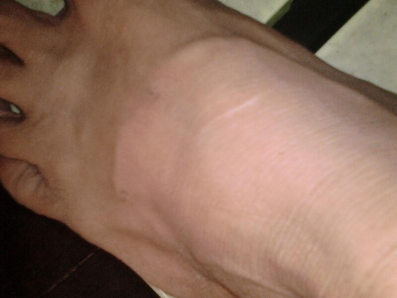 &#91;SHARE&#93; obat luka mujarab itu ternyata ada di dapur kita